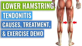 Three Simple Distal Hamstring Tendinopathy Exercises