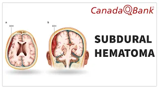 Subdural Hematoma