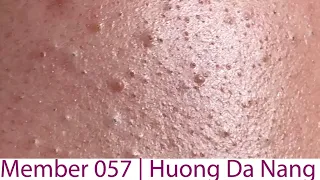 Acne Treatment Huong Da Nang# 057 |  Member 2023