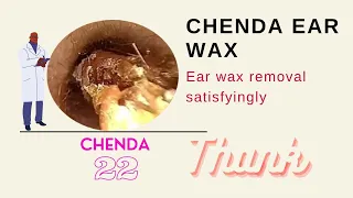 Chenda cleaning ear wax removal, exam, and ear wax Chinese ear cleaning,#1