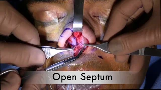 Open Septoplasty