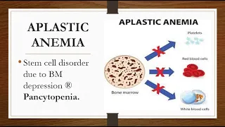 APLASTIC HYPOPLASTIC ANEMIA