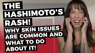 THE HASHIMOTO'S RASH! Why skin issues are common and what to do about it!