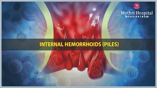 Internal Hemorrhoids (Piles) | Mythri Hospital Mehdipatnam #Shorts