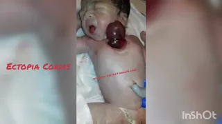 Real Ectopia Cordis (Baby borne with heart outside her body) #surgeryvlog #baby #heart #shortsvideo