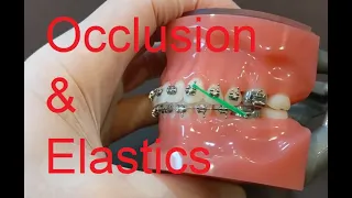 Occlusion & Elastics