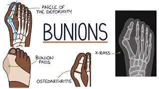 Understanding Bunions (Hallux Valgus)