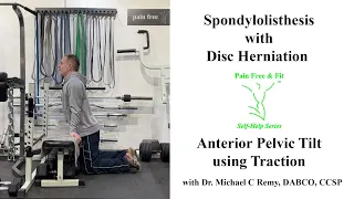 Spondylolisthesis with Disc Herniation Exercises- When "Tail Under" is Dangerous