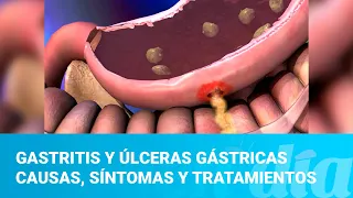 Gastritis y úlceras gástricas causas, síntomas y tratamientos