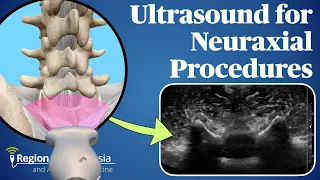 Ultrasound for Neuraxial Procedures