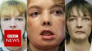 First face transplant patient Isabelle Dinoire dies - BBC News