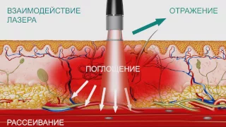 Лазер высокой интенсивности BTL-6000 HIL. Особенности технологии и медицинские эффекты.