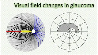 Visual field changes in glaucoma