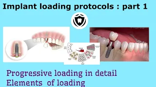 Implant Loading Protocols : Part 1