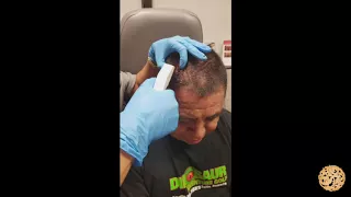 Staples To Scalp Laceration | Nazarian Plastic Surgery