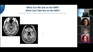 Overview of MCI and Dementia - James Lah MD, PhD