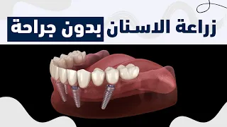 زراعة الاسنان بدون جراحة  | د. حمدي العوضي