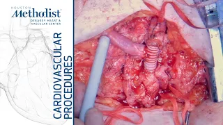 Common Iliac and Common Femoral Artery Aneurysm Repair (A.Lumsden, MD; M.Zubair, MD; S.Timbalia, MD)