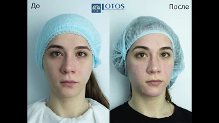 Процедура пилинга V45 Triple Acid Skin Peel c мезороллером