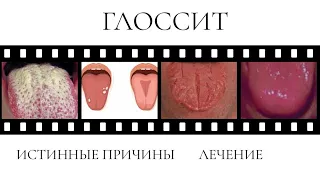 ГЛОССИТ/👅ТРЕЩИНЫ И НАЛЕТ НА ЯЗЫКЕ👄