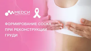 Формирование соска после мастэктомии // Реконструкция молочной железы // Реконструкция соска #рмж