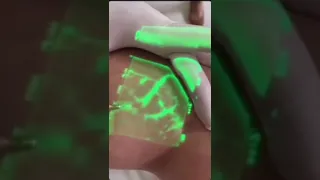 Awesome development — VeinViewer Flex  With the help of infrared light, it highlights the veins so t