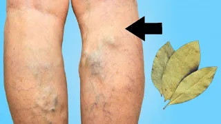 Say goodbye👋 to varicose veins and joint pain with just this one Herb leaf - effective 100%.