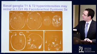 Clinical Pearls in Autoimmune Encephalopathy - Eoin Flanagan, M.D.