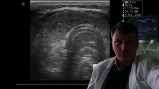 Thyroid ultrasound - Hashimoto's goiter  / Hashimoto's Thyroiditis / Hashimoto's disease