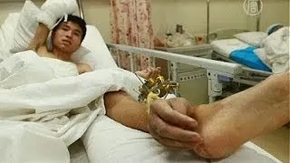 Китайские врачи спасли руку пациента, пришив ее к ноге (новости)