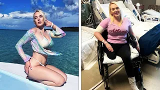 Model’s Leg Amputated After Flesh-Eating Bacteria Infection