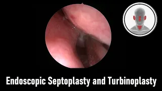 Endoscopic Septoplasty and Turbinoplasty
