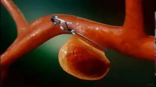 Aneurysm Clipping Surgery - Animation