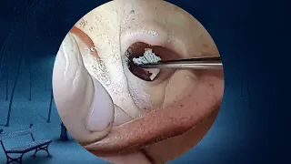 earwax water removal The first person to clean earwax after 27 years of life 04