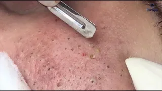 Full Blackhead Popping Video - HOT 2019 - Part 2 - Continue