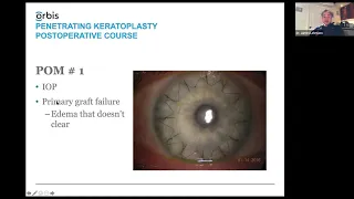 Lecture: Postoperative Management of Penetrating Keratoplasty