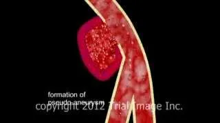 Pseudoaneurysm video - Animation by Cal Shipley, M.D. Trial Image Inc.