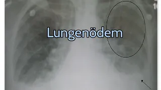 Lungenödem / Erkrankung der Atemwege