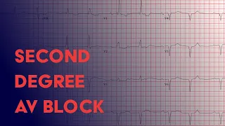 Second Degree Heart Block -  Electrocardiogram (ECG/EKG) Interpretation