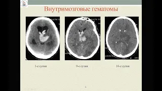 Травматические кровоизлияния 1