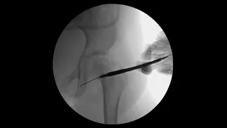 Tractionless Hip Arthroscopy for Septic Arthritis in Children