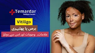 Vitiligo causes,symptoms, treatment| Vitiligo kya hai | bars ki almaat, wajuhat aur elaj(urdu/hindi)
