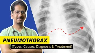 PNEUMOTHORAX- Types, Causes, Diagnosis & Treatment || Detailed video