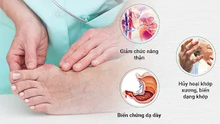 GIẢM SƯNG, ĐAU NHỨC KHỚP DO GÚT, GIẢM ACID URIC Ở NGƯỜI BỆNH GÚT CẤP VÀ MẠN TÍNH | VTC16