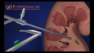 Super‐mini percutaneous nephrolithotomy