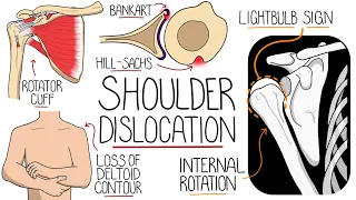 Shoulder Dislocation Explained Clearly (Glenohumeral Joint Dislocation)