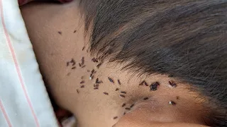 Take out all hundred lice from hair - Remove lice from short hair
