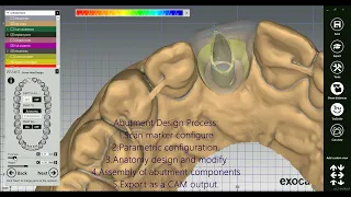 How to design a Screw Retained Crown in #exocad