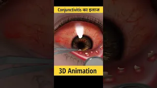 आंख अजाए तो कैसे ठीक करते हैं? | conjunctivitis treatment in 3D animation #shorts #conjuctivitis