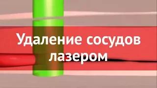 Лазерное удаление капилляров и сосудов